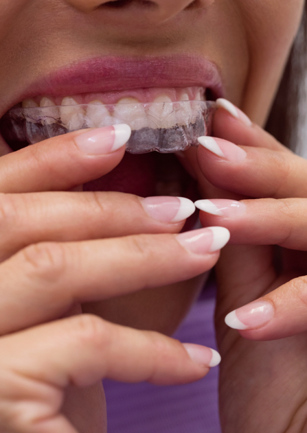 Invisalign (Şeffaf Plak Tedavisi)