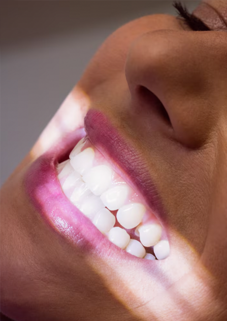 Lamine Kaplama (Diş Estetiği)